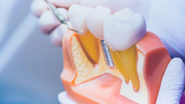 Prothèses dentaires et solutions d’implants : contacter un spécialiste en ligne