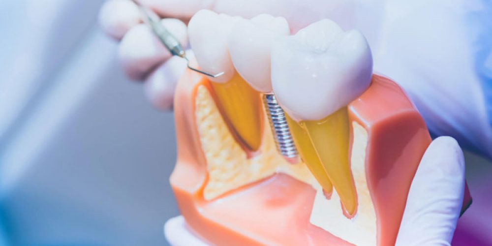 Prothèses dentaires et solutions d’implants : contacter un spécialiste en ligne